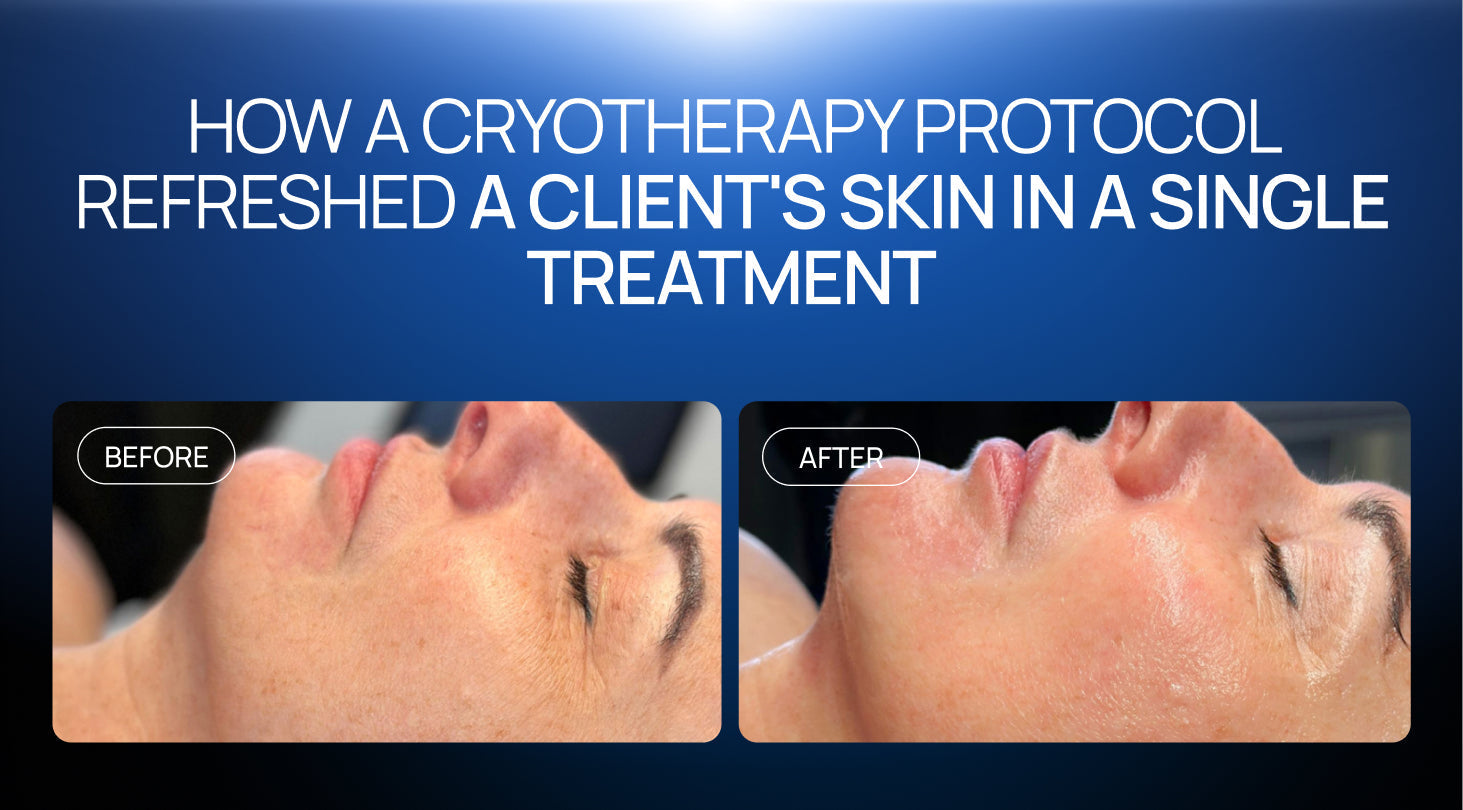 How a Cryotherapy Protocol Refreshed a Client's Skin in a Single Treatment
