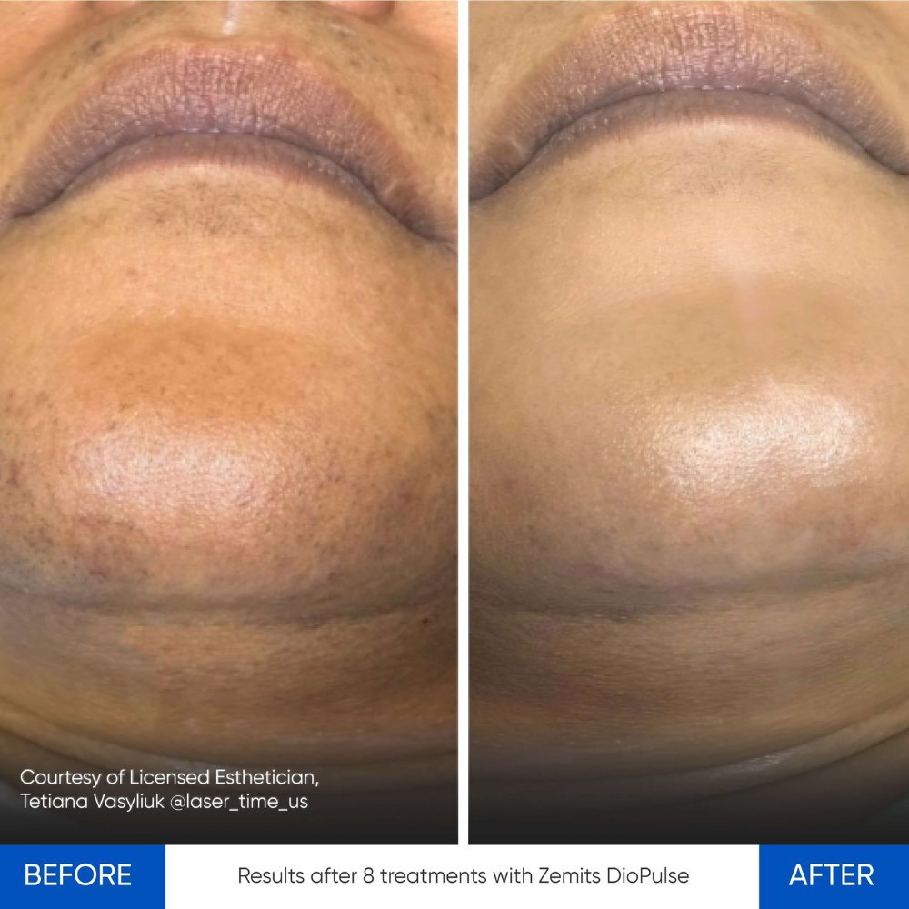 Before After Slide 1